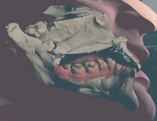 The jaw bone and teeth from a CBCT scan, shown inside the aligned 3D model.
