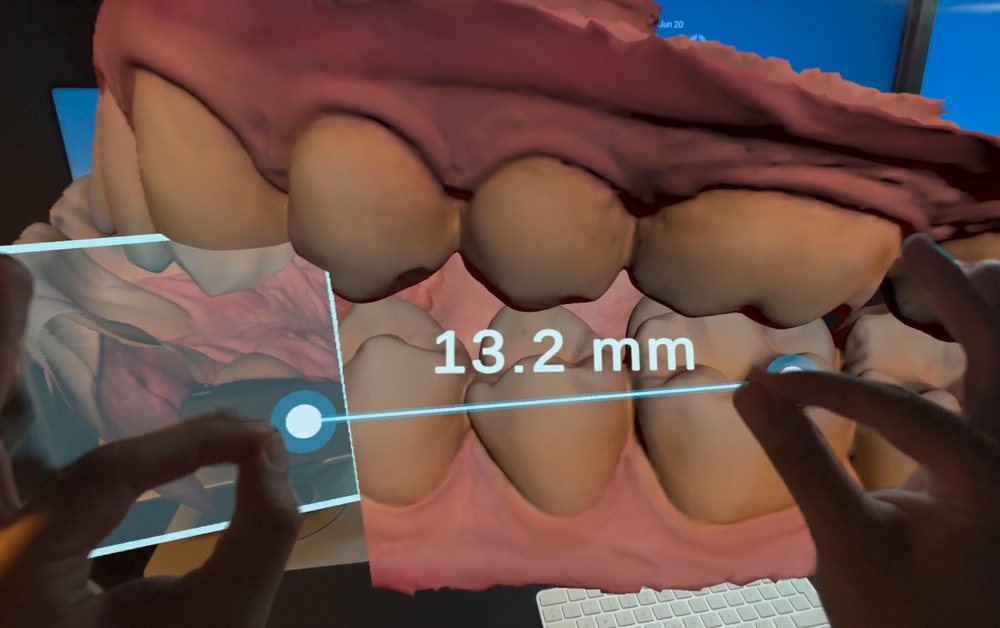Two hands holding the ends of a ruler across an aligned 3D dental scan. The ruler shows the distance in millimetres.